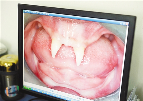 贵州：16岁男孩身患罕见基因病只长两颗“獠牙”